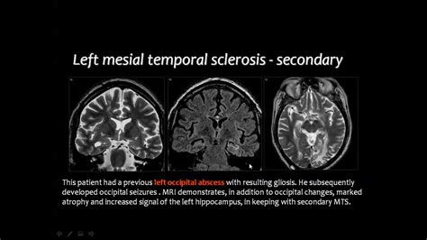 Gliosis Mri - IMobile Cool