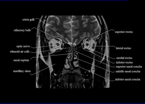 Orbits Anatomy |MRI Orbits and Paranasal Sinuses Anatomy | Free Cross ...