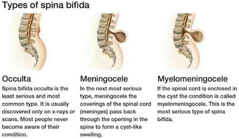 Spina Bifida - PT Master Guide