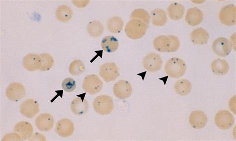 Reticulocytes – Cells and Smears