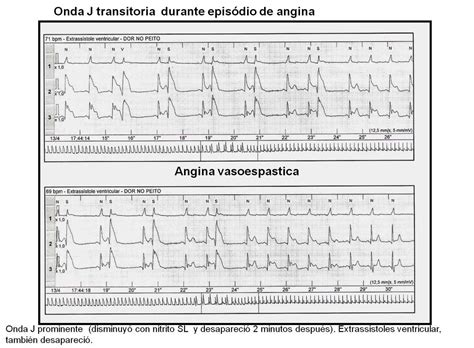 Prinzmetal angina during Holter ECG. Normal Coronary Arteries - Imágenes | Cardiolatina ...