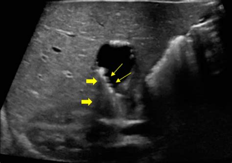 Follow-up ultrasound at 3 months of age shows persistence of ...