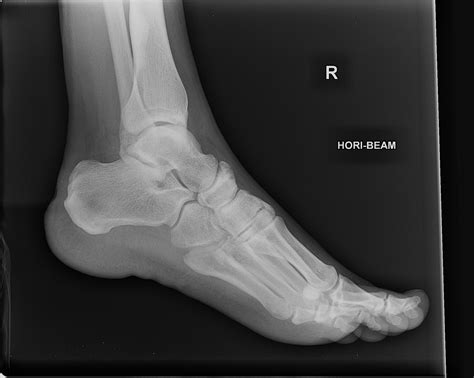 X Ray Foot Normal