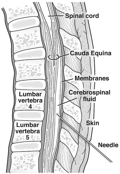 Lumbar Drain | Treatments | Patients & Families | UW Health