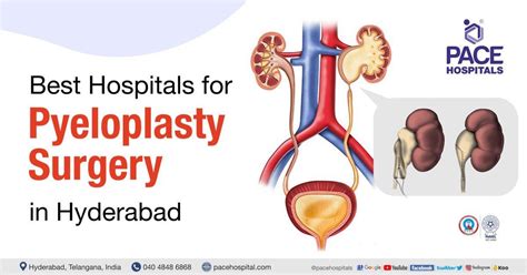 Pyeloplasty Surgery in Hyderabad - Procedure Indications, Types & Cost