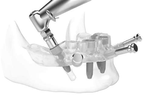 Traditional vs Digitally Guided Implant Surgery - How Do They Differ?