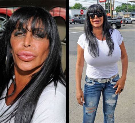 31 Plastic Surgery Gone Wrong Pictures That Will Make You Feel ...