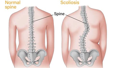 Can scoliosis cause back pain? - FITPAA