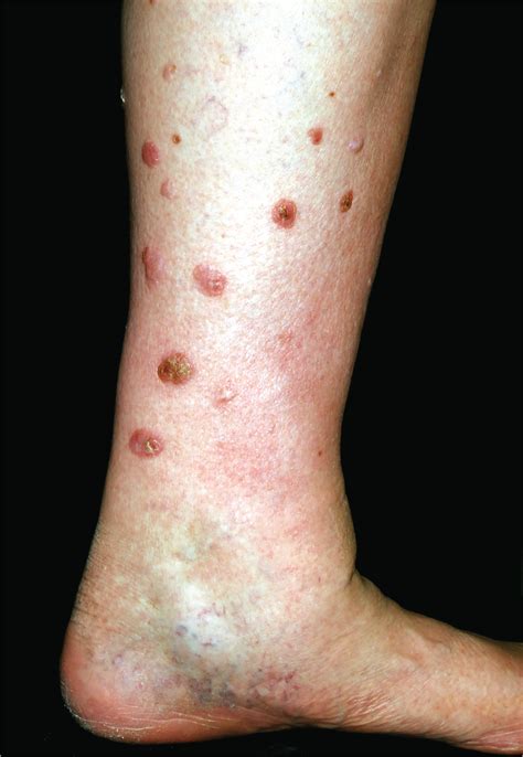 Multiple Slowly Growing Nodular Lesions on the Lower Legs in a 78-Year-Old Obese Woman ...