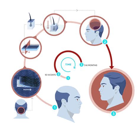 Getting to know Hair Transplant Techniques