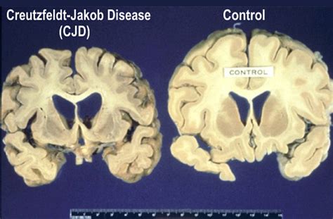 Creutzfeldt-Jakob Disease, CJD - Health And Medical Information