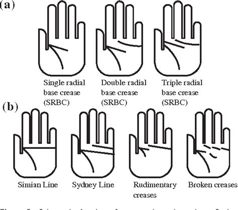 Figure 3 from Dermatoglyphics and abnormal palmar flexion creases as markers of early prenatal ...