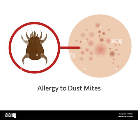 Skin allergy to dust mites vector illustration design Stock Vector ...