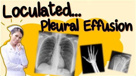 CHEST X-ray : Loculated Pleural Effusion - YouTube