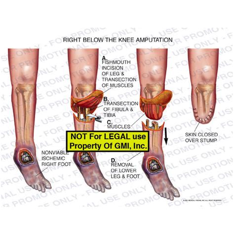 Right Below The Knee Amputation 01089b – Generic Medical Legal Exhibits, A Division of MVI