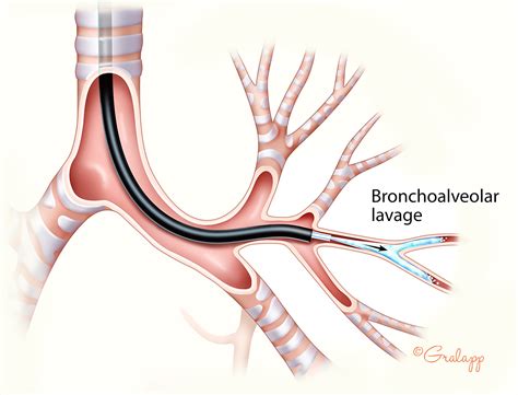 One Bronchoscopy, Two Errors | PSNet