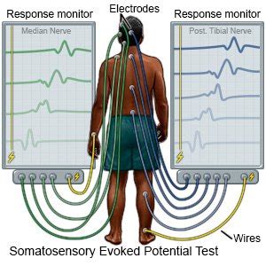 Evoked Potential Tests - What You Need to Know