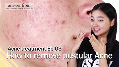 Acne treatment Ep 03 : How to remove Pustules Acne - YouTube