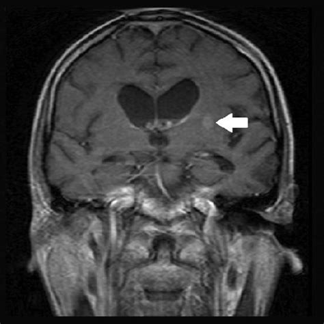 Magnetic resonance imaging performed on admission. Hyperintense lesion ...