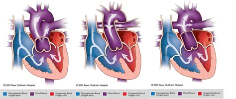 Truncus Arteriosus | Pediatric Echocardiography