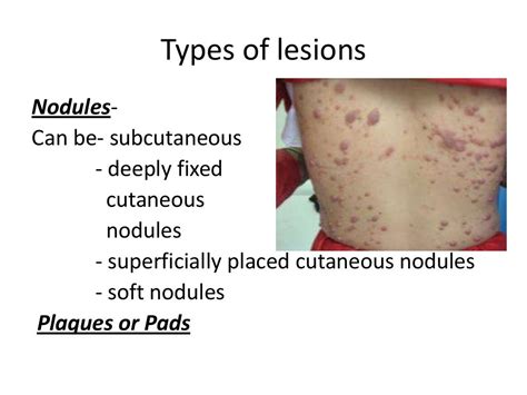 Histoid leprosy