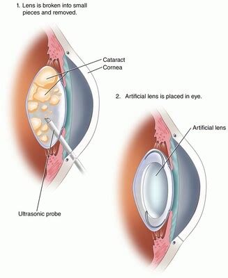 Phacoemulsification Cataract Surgery - Eyemantra Cataract Eye Surgery