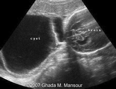 📃 Cranial meningocele