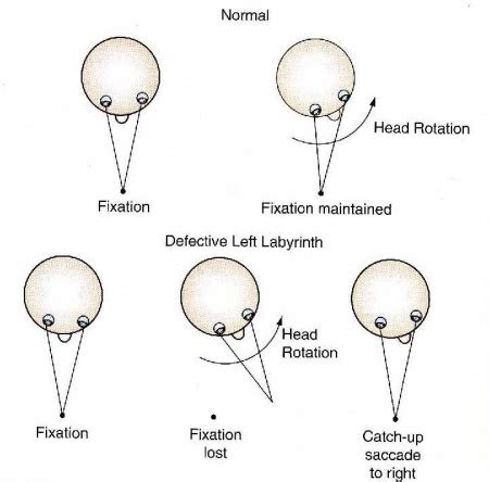 Head impulse test - Neurosigns