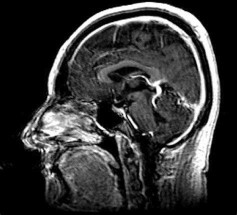 Sagittal MRI demonstrating an enlarged occipital dural venous sinus.... | Download Scientific ...