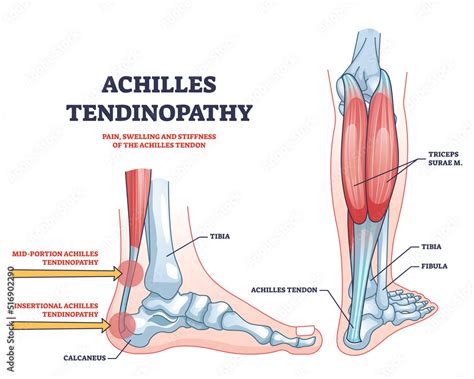 Achilles Tendon Anatomy Diagram