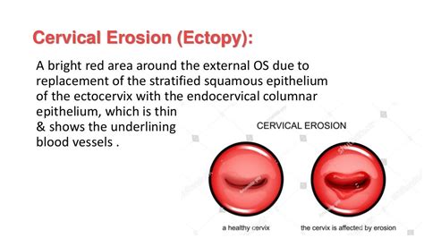 Benign Cervical Lesions