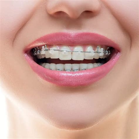 Clear Braces Guide: Information on Types & Costs in the UK