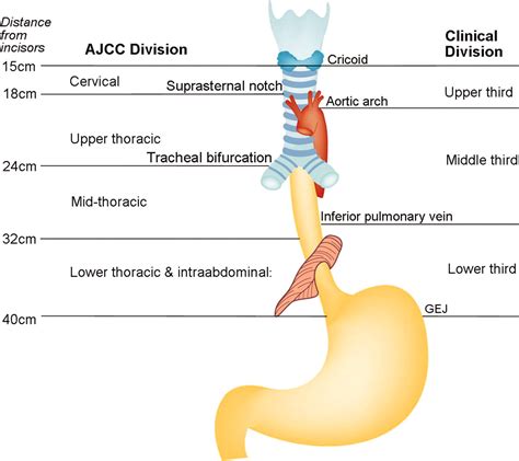 Multimodality Assessment of Esophageal Cancer: Preoperative Staging and ...