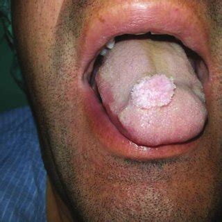 (PDF) Verruca vulgaris of the tongue: A case report with literature review