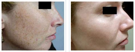 Beverly Hills Photofacial IPL for Pigmentation and Sun Damage - John Sedgh, M.D