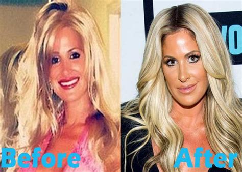 Kim Zolciak Plastic Surgery: Fact or Rumor | Kim Zolciak Plastic Surgery