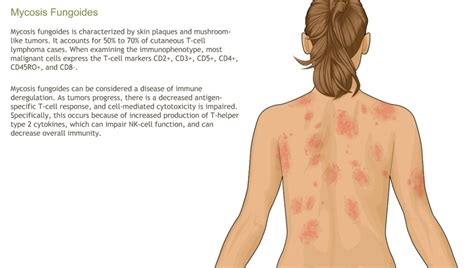 Nonhodgkin's Lymphoma