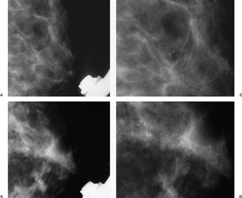 Calcifications: Small Round/Punctate | Radiology Key