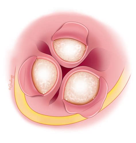 Exostoses of the Ear Canal – Oto Surgery Atlas