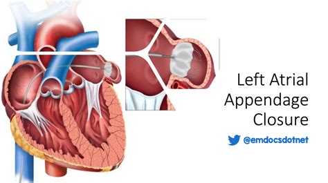 emDOCs.net – Emergency Medicine EducationLeft atrial appendage closure: procedure basics ...