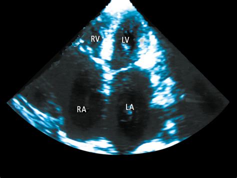 Figure 031_4106. Echocardiography (apical 4-chamber view) of a patient ...