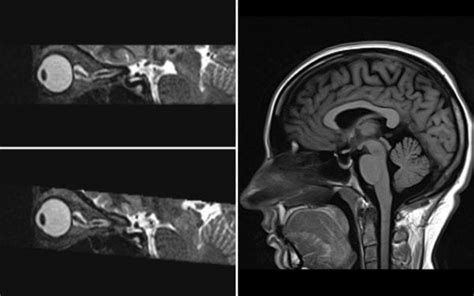 Intracranial hypertension: Beyond CSF. Diagnosis and treatment - MSK ...