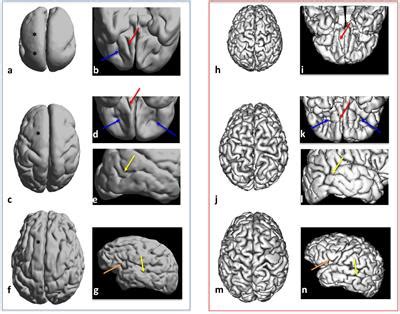 Frontiers | Structural and Diffusion MRI Analyses With Histological Observations in Patients ...