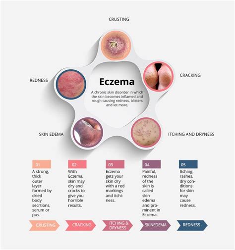 Dyshidrotic Eczema Body