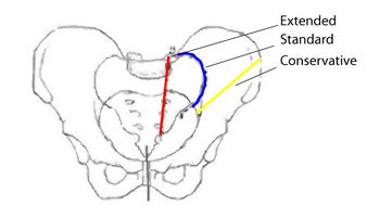 Hemipelvectomy