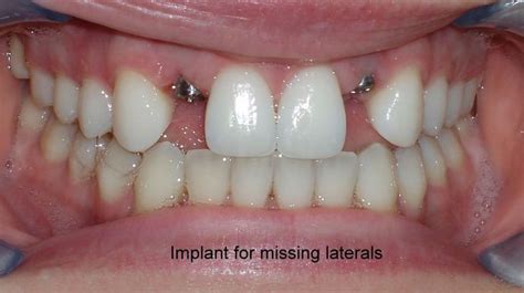 Anterior Dental Implants - Dental Implants - Before and After Gallery