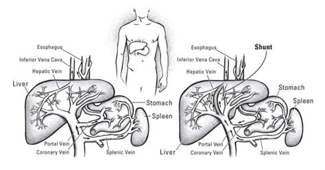 Coronary Vein Portal Hypertension