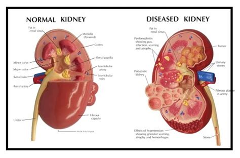 Chronic Kidney Diseases: Mycotoxin-Induced Chronic Kidney Disease