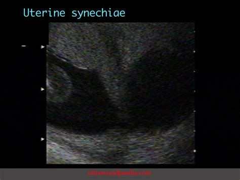 Uterine synechiae – ULTRASOUNDPAEDIA