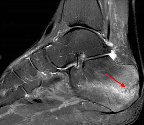 Heel pain causes, symptoms, diagnosis, pain relief & heel pain treatment